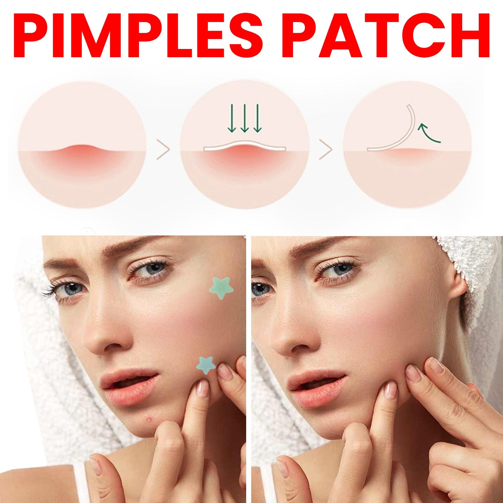 Acne Patch Dots-Invisible Pimple Treatment (200 Patches)